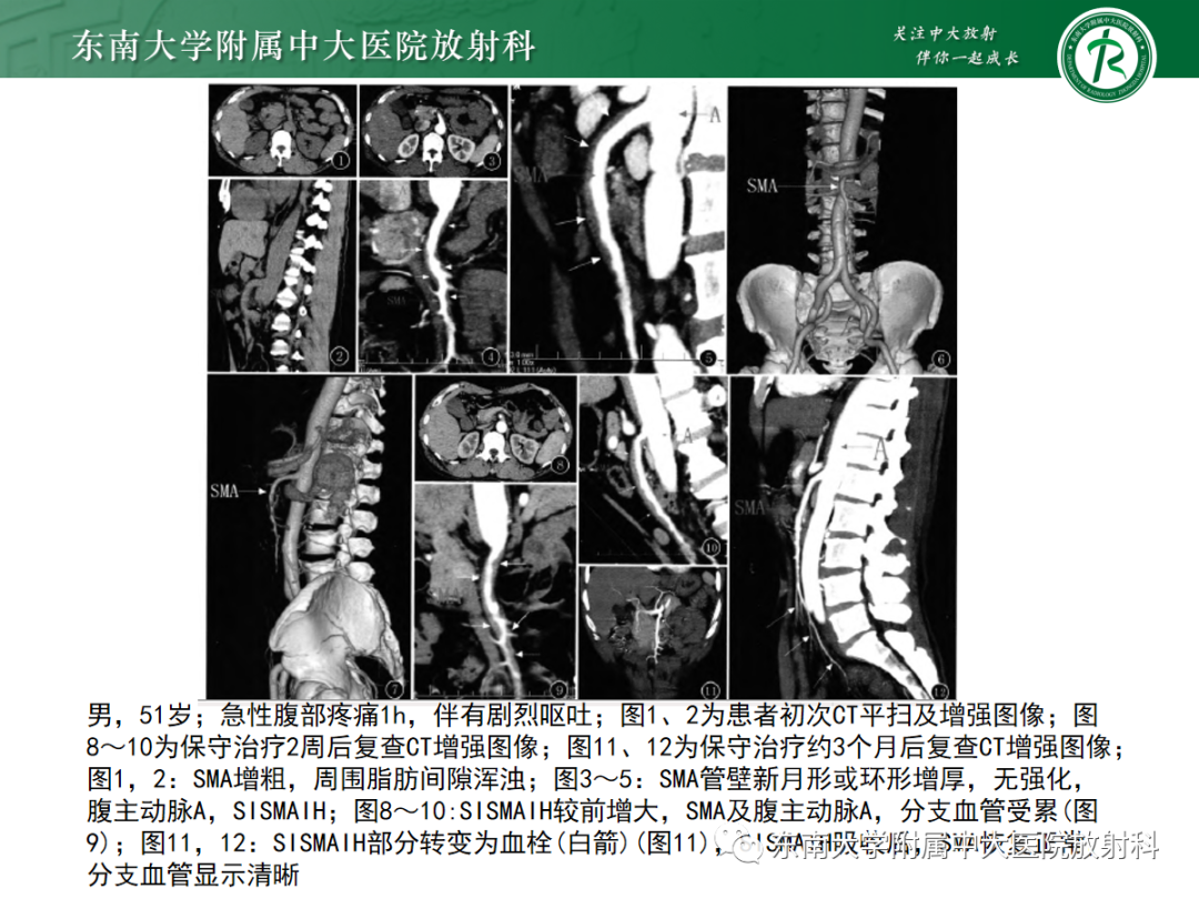 影像PPT - 【PPT】孤立性肠系膜上动脉夹层-27