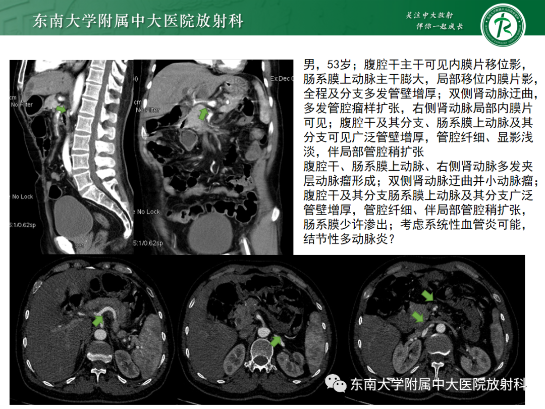影像PPT - 【PPT】孤立性肠系膜上动脉夹层-29