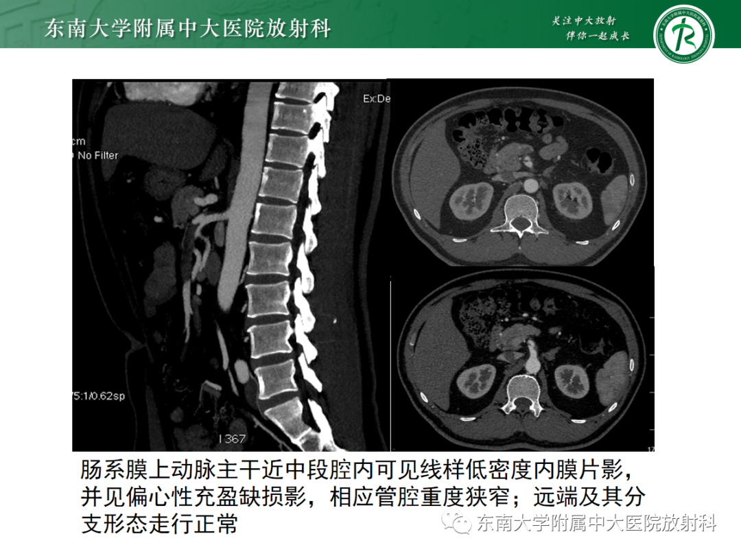 影像PPT - 【PPT】孤立性肠系膜上动脉夹层-1