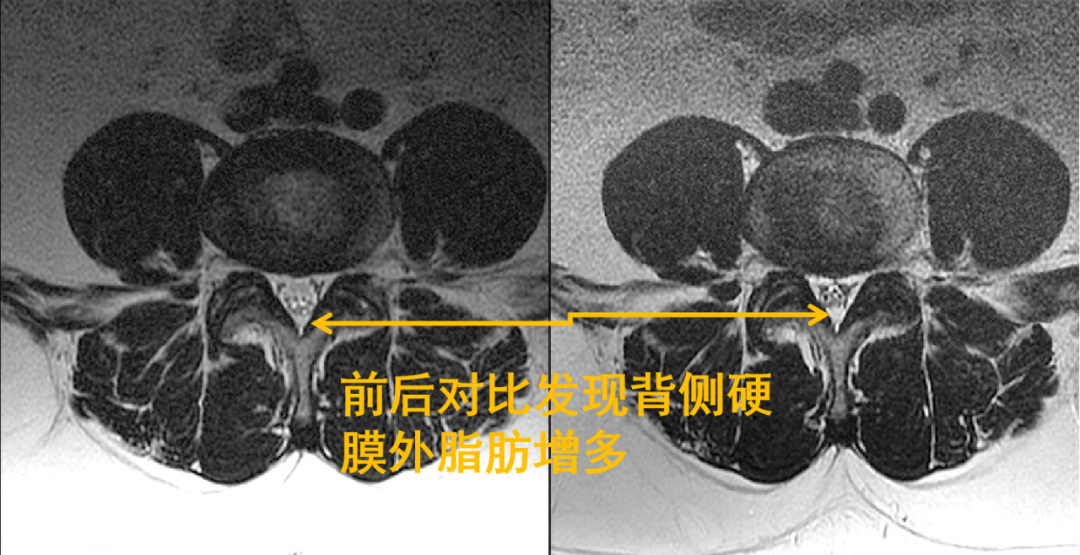 影像PPT - 常见易忽略的疾病—椎管内硬膜外脂肪增多症-9 影像PPT - 常见易忽略的疾病—椎管内硬膜外脂肪增多症-9