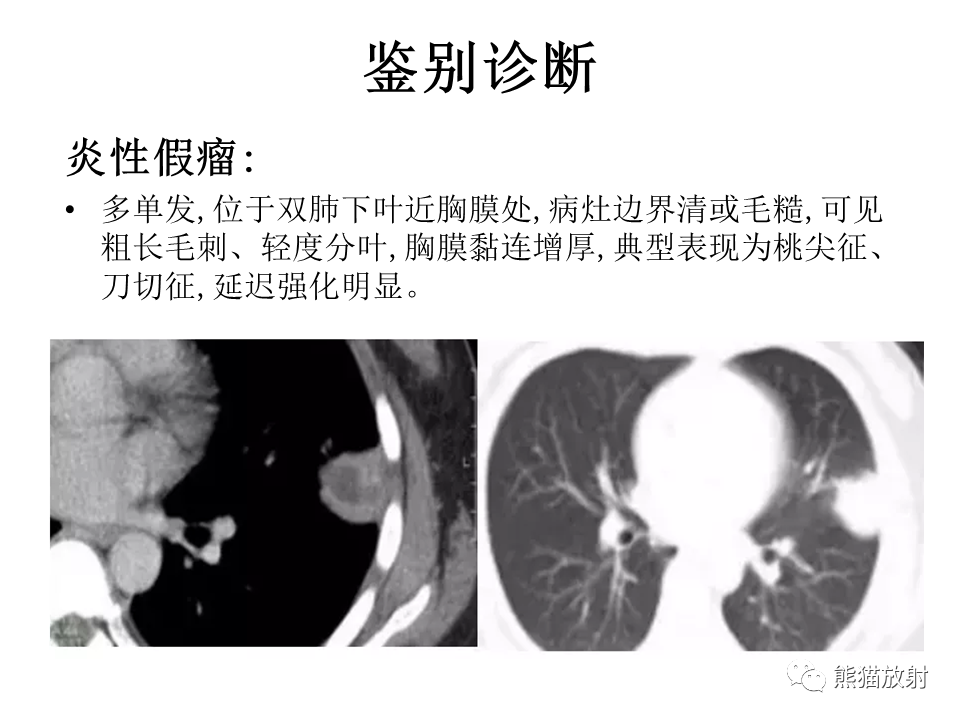 影像PPT - 【病例】胸膜孤立性纤维瘤 VS 胸壁神经鞘瘤-24