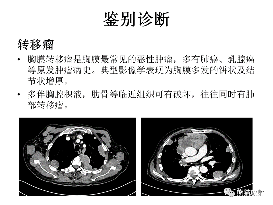影像PPT - 【病例】胸膜孤立性纤维瘤 VS 胸壁神经鞘瘤-25