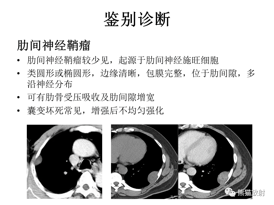 影像PPT - 【病例】胸膜孤立性纤维瘤 VS 胸壁神经鞘瘤-22