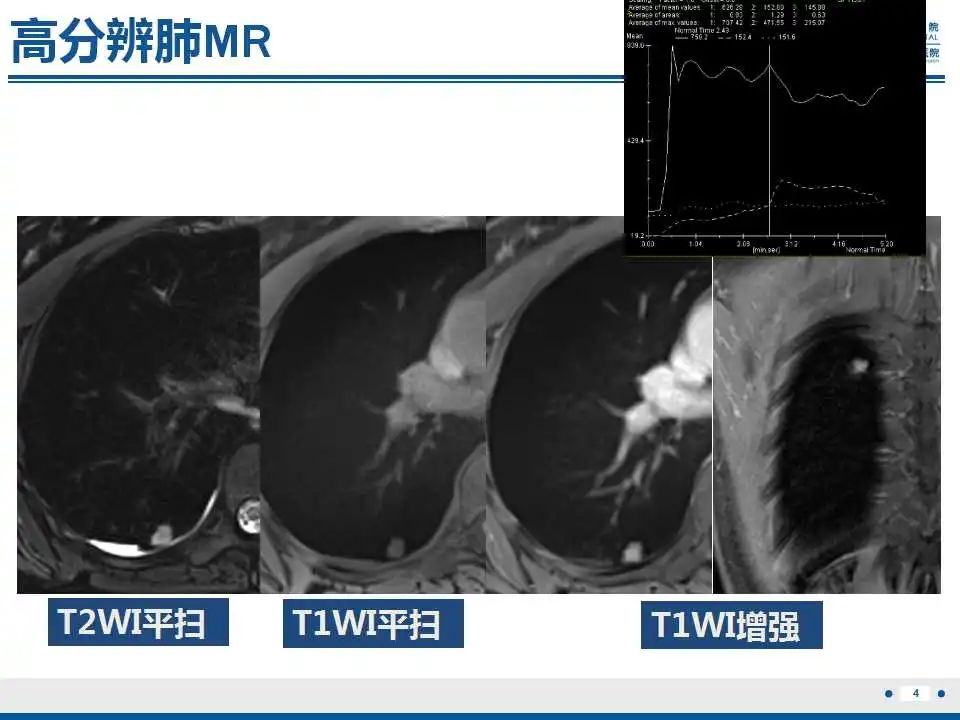 影像PPT - 【PPT】细支气管腺癌-5