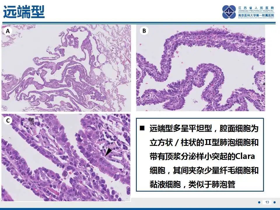 影像PPT - 【PPT】细支气管腺癌-14