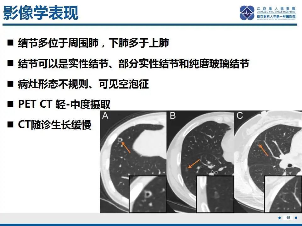 影像PPT - 【PPT】细支气管腺癌-16