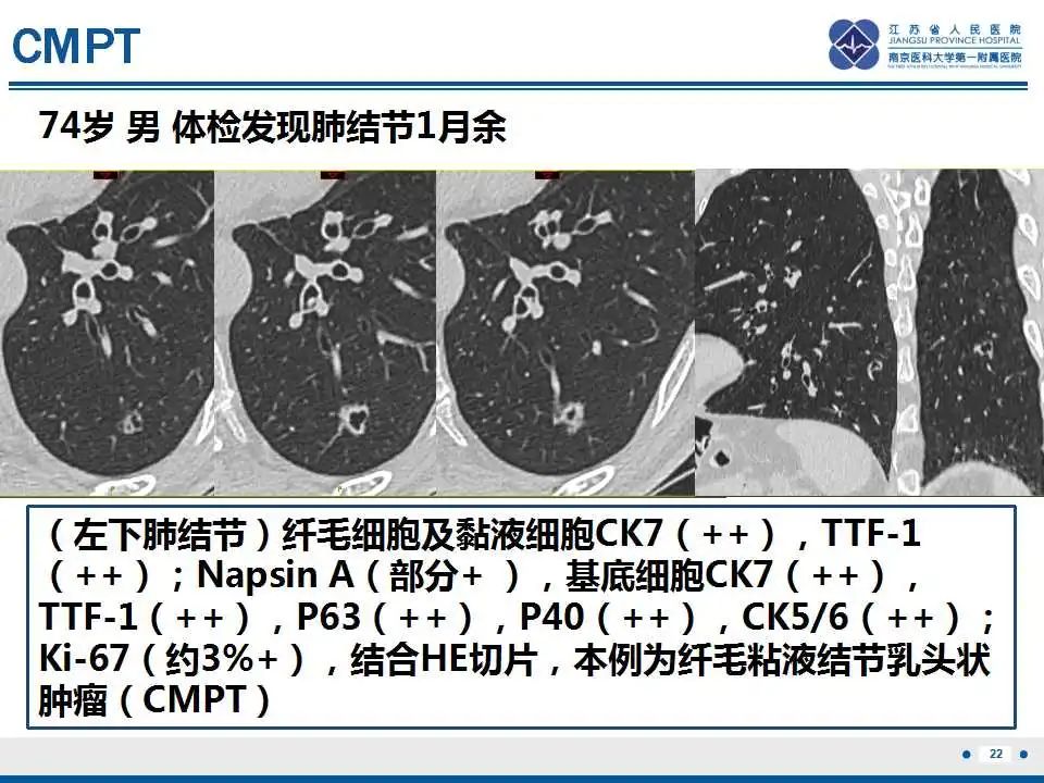 影像PPT - 【PPT】细支气管腺癌-23
