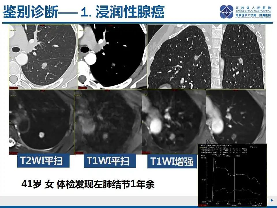 影像PPT - 【PPT】细支气管腺癌-24