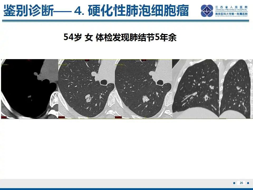 影像PPT - 【PPT】细支气管腺癌-27
