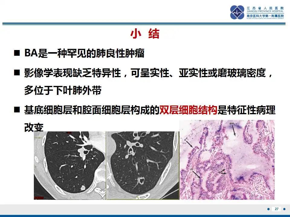 影像PPT - 【PPT】细支气管腺癌-28