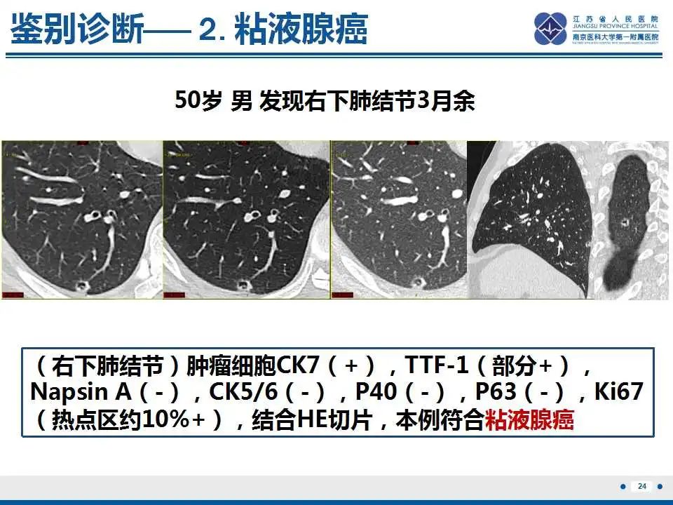影像PPT - 【PPT】细支气管腺癌-9