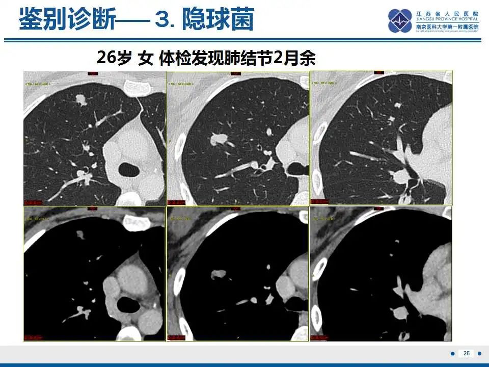 影像PPT - 【PPT】细支气管腺癌-10