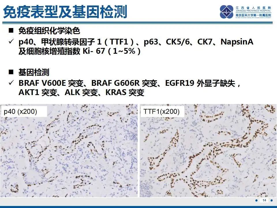 影像PPT - 【PPT】细支气管腺癌-2