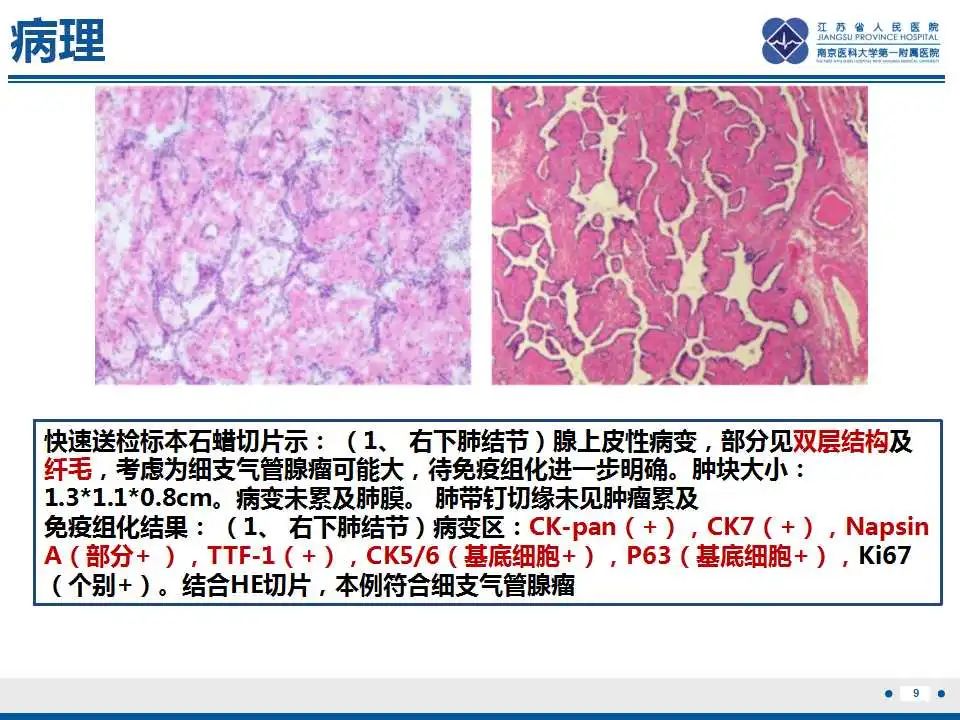 影像PPT - 【PPT】细支气管腺癌-1