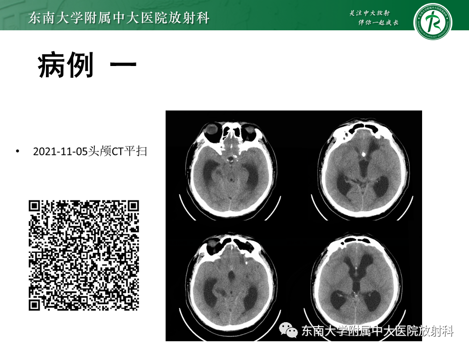 影像PPT - 【PPT】颅内多发环形强化的诊断思路-17 影像PPT - 【PPT】颅内多发环形强化的诊断思路-17