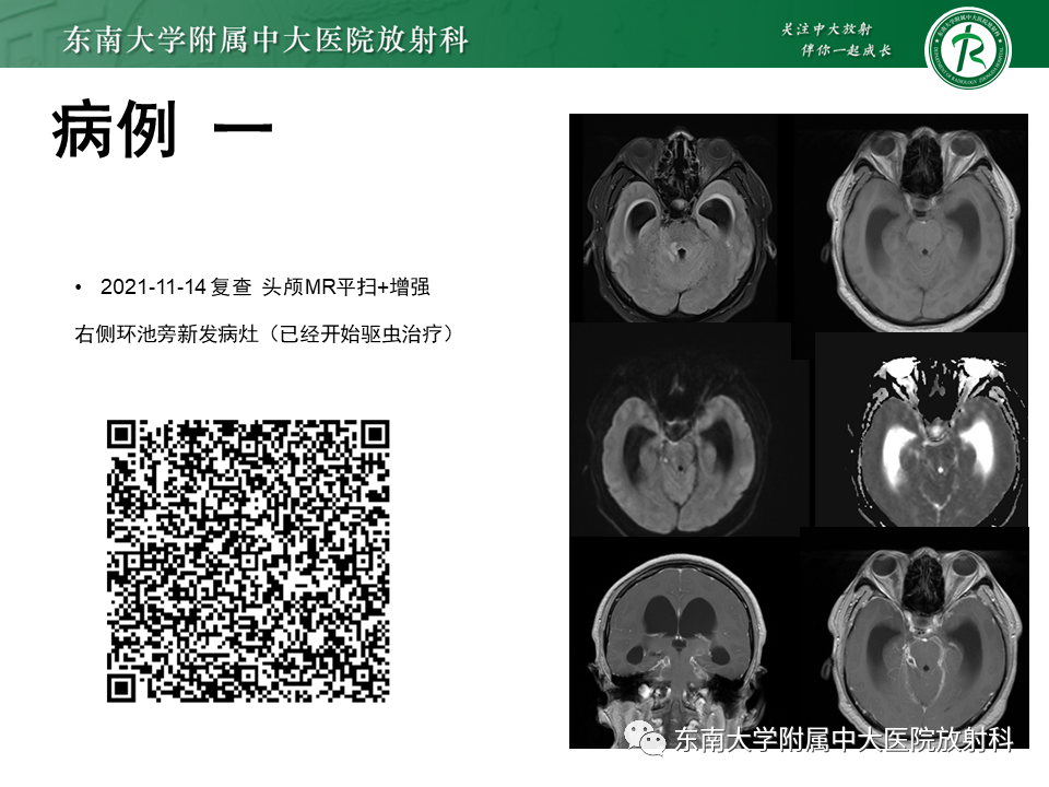 影像PPT - 【PPT】颅内多发环形强化的诊断思路-19 影像PPT - 【PPT】颅内多发环形强化的诊断思路-19