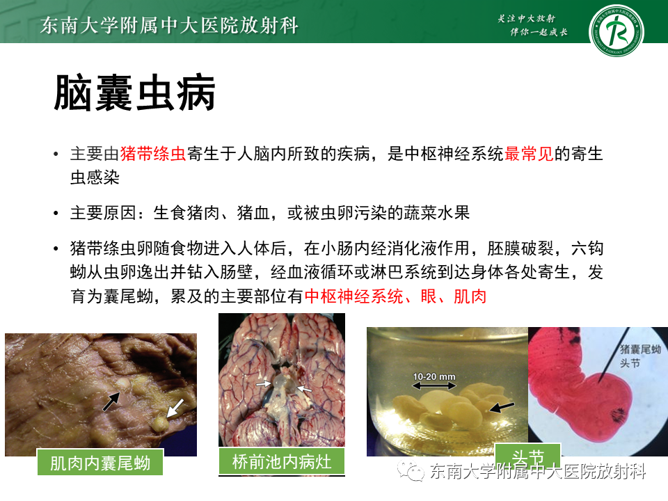 影像PPT - 【PPT】颅内多发环形强化的诊断思路-36 影像PPT - 【PPT】颅内多发环形强化的诊断思路-36