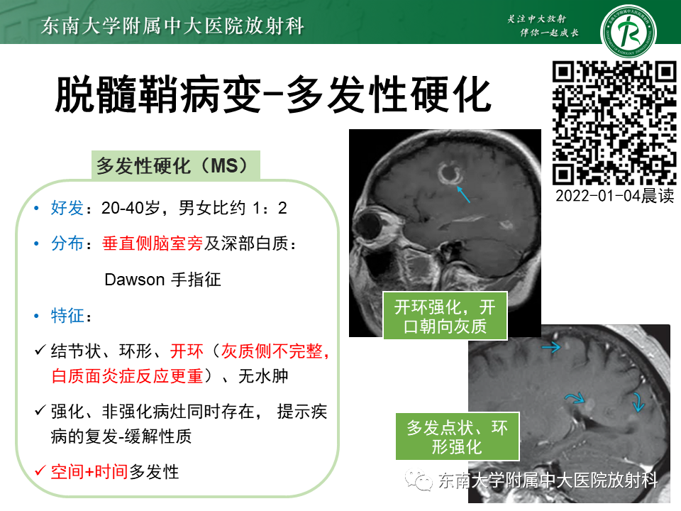 影像PPT - 【PPT】颅内多发环形强化的诊断思路-34 影像PPT - 【PPT】颅内多发环形强化的诊断思路-34