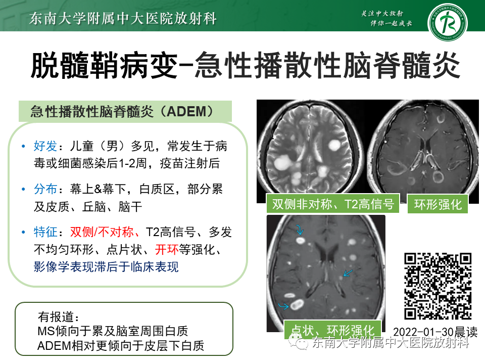 影像PPT - 【PPT】颅内多发环形强化的诊断思路-35 影像PPT - 【PPT】颅内多发环形强化的诊断思路-35