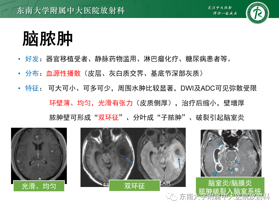 影像PPT - 【PPT】颅内多发环形强化的诊断思路-33 影像PPT - 【PPT】颅内多发环形强化的诊断思路-33