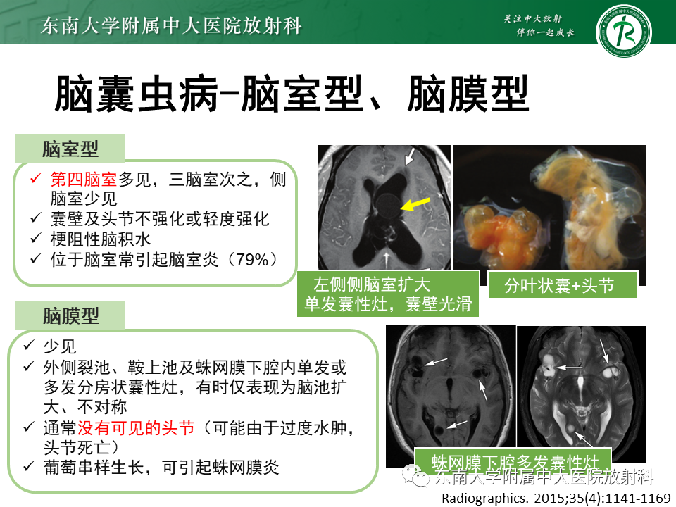 影像PPT - 【PPT】颅内多发环形强化的诊断思路-43 影像PPT - 【PPT】颅内多发环形强化的诊断思路-43