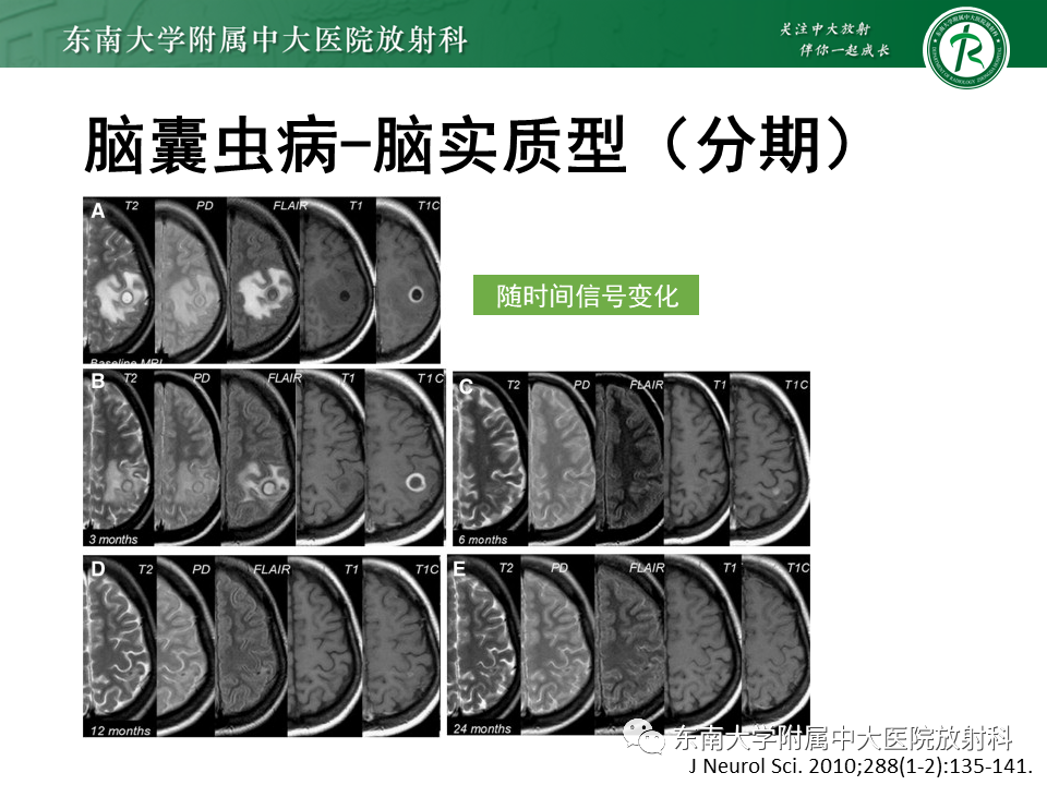 影像PPT - 【PPT】颅内多发环形强化的诊断思路-41 影像PPT - 【PPT】颅内多发环形强化的诊断思路-41