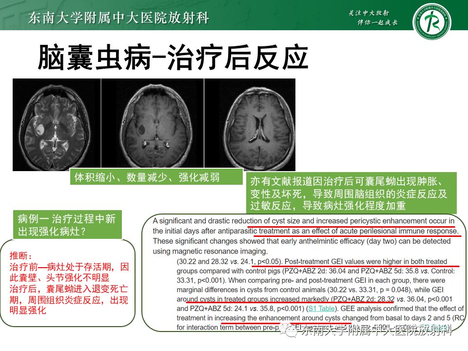 影像PPT - 【PPT】颅内多发环形强化的诊断思路-42 影像PPT - 【PPT】颅内多发环形强化的诊断思路-42
