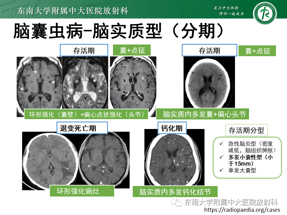 影像PPT - 【PPT】颅内多发环形强化的诊断思路-40 影像PPT - 【PPT】颅内多发环形强化的诊断思路-40