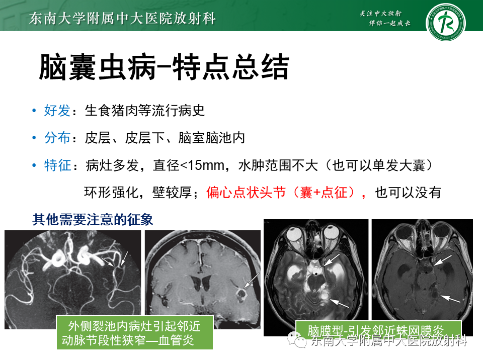影像PPT - 【PPT】颅内多发环形强化的诊断思路-45 影像PPT - 【PPT】颅内多发环形强化的诊断思路-45