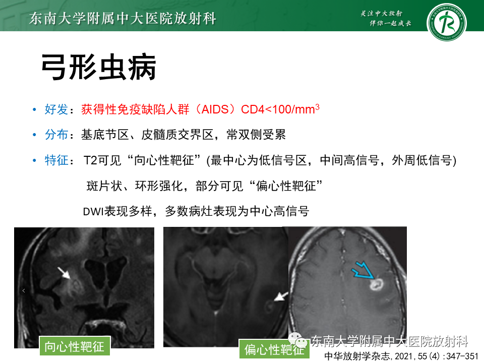 影像PPT - 【PPT】颅内多发环形强化的诊断思路-47 影像PPT - 【PPT】颅内多发环形强化的诊断思路-47