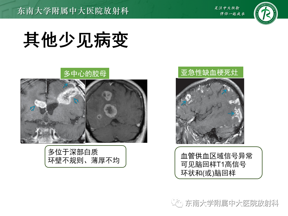 影像PPT - 【PPT】颅内多发环形强化的诊断思路-49 影像PPT - 【PPT】颅内多发环形强化的诊断思路-49