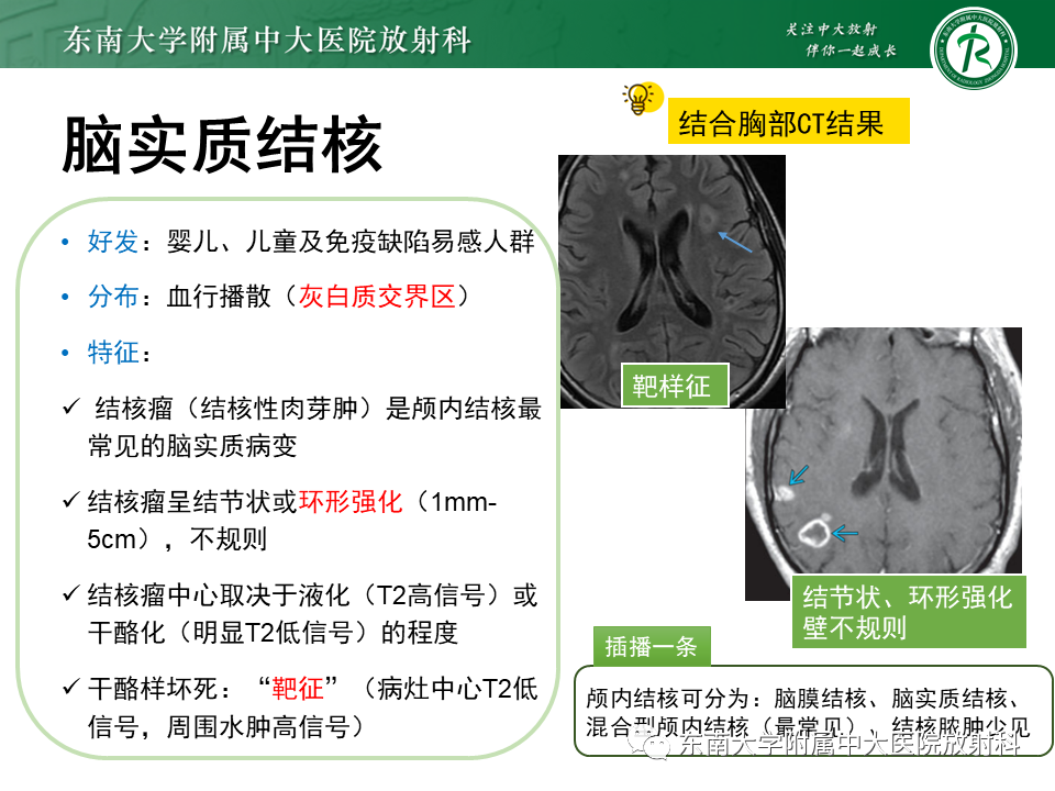 影像PPT - 【PPT】颅内多发环形强化的诊断思路-46 影像PPT - 【PPT】颅内多发环形强化的诊断思路-46