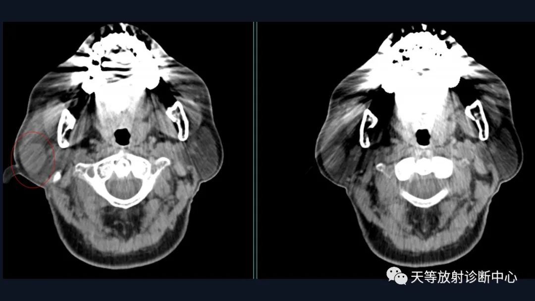 影像PPT - 【病例】环形强化腮腺占位—淋巴上皮囊肿1例-5 影像PPT - 【病例】环形强化腮腺占位—淋巴上皮囊肿1例-5