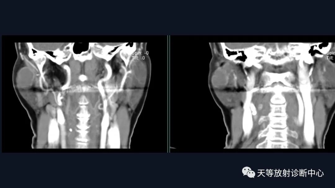 影像PPT - 【病例】环形强化腮腺占位—淋巴上皮囊肿1例-15 影像PPT - 【病例】环形强化腮腺占位—淋巴上皮囊肿1例-15
