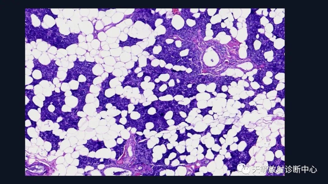 影像PPT - 【病例】环形强化腮腺占位—淋巴上皮囊肿1例-18 影像PPT - 【病例】环形强化腮腺占位—淋巴上皮囊肿1例-18