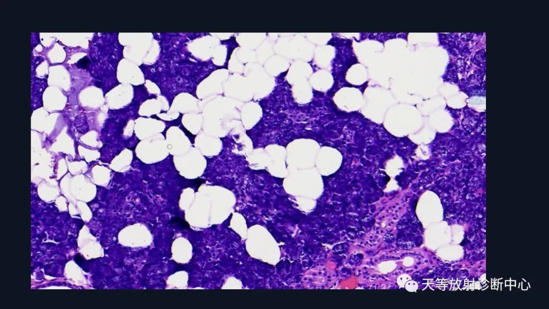 影像PPT - 【病例】环形强化腮腺占位—淋巴上皮囊肿1例-17 影像PPT - 【病例】环形强化腮腺占位—淋巴上皮囊肿1例-17