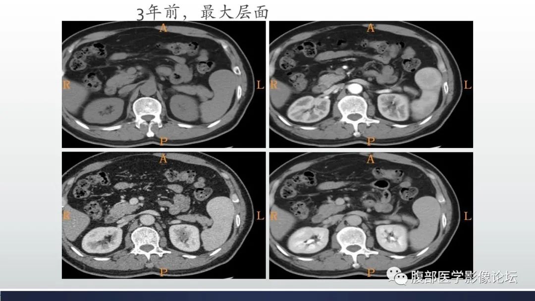 影像PPT - 【病例】脾脏窦岸细胞血管瘤2例影像诊断-14