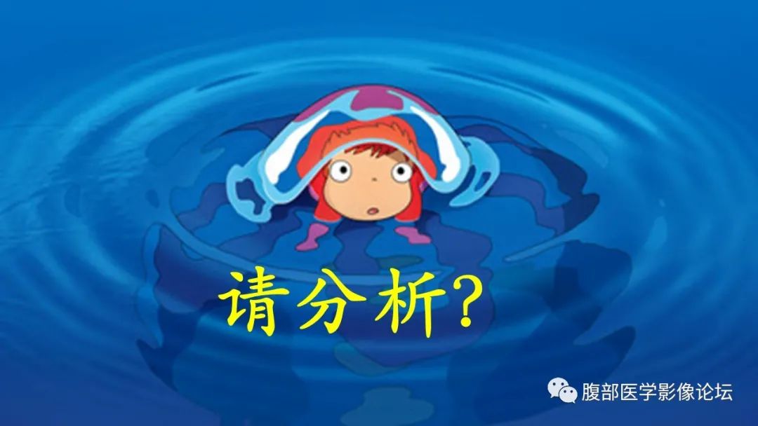 影像PPT - 【病例】脾脏窦岸细胞血管瘤2例影像诊断-15