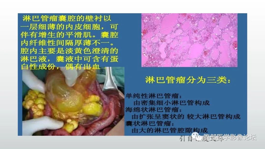 影像PPT - 【病例】脾脏窦岸细胞血管瘤2例影像诊断-30
