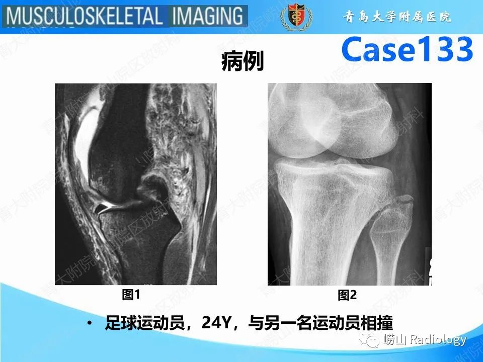 影像PPT - 【PPT】后交叉韧带撕裂-2
