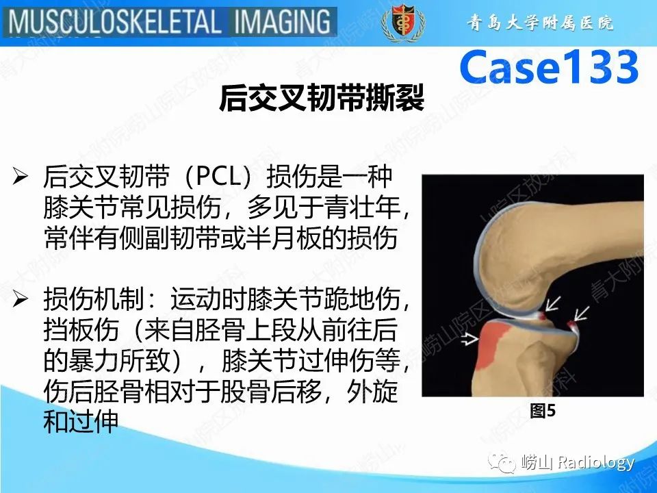 影像PPT - 【PPT】后交叉韧带撕裂-7