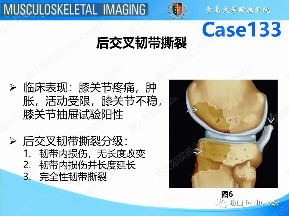 影像PPT - 【PPT】后交叉韧带撕裂-8