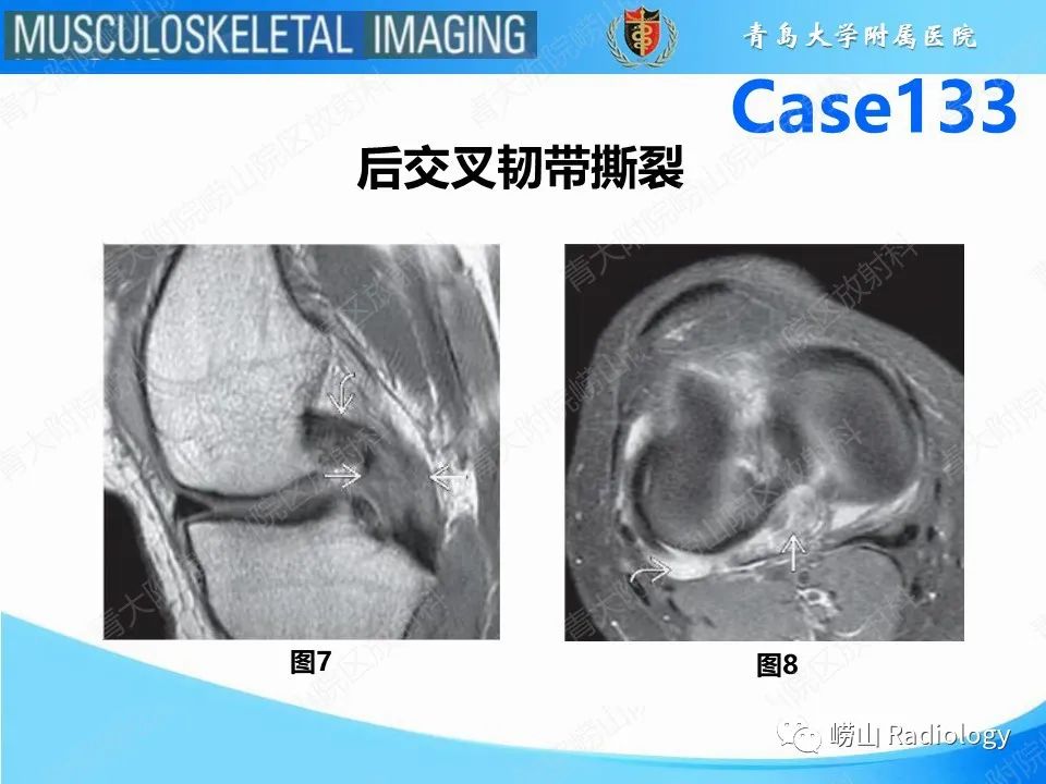 影像PPT - 【PPT】后交叉韧带撕裂-9