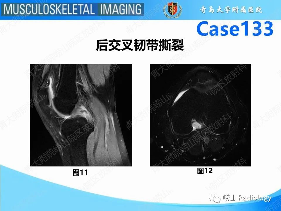 影像PPT - 【PPT】后交叉韧带撕裂-11
