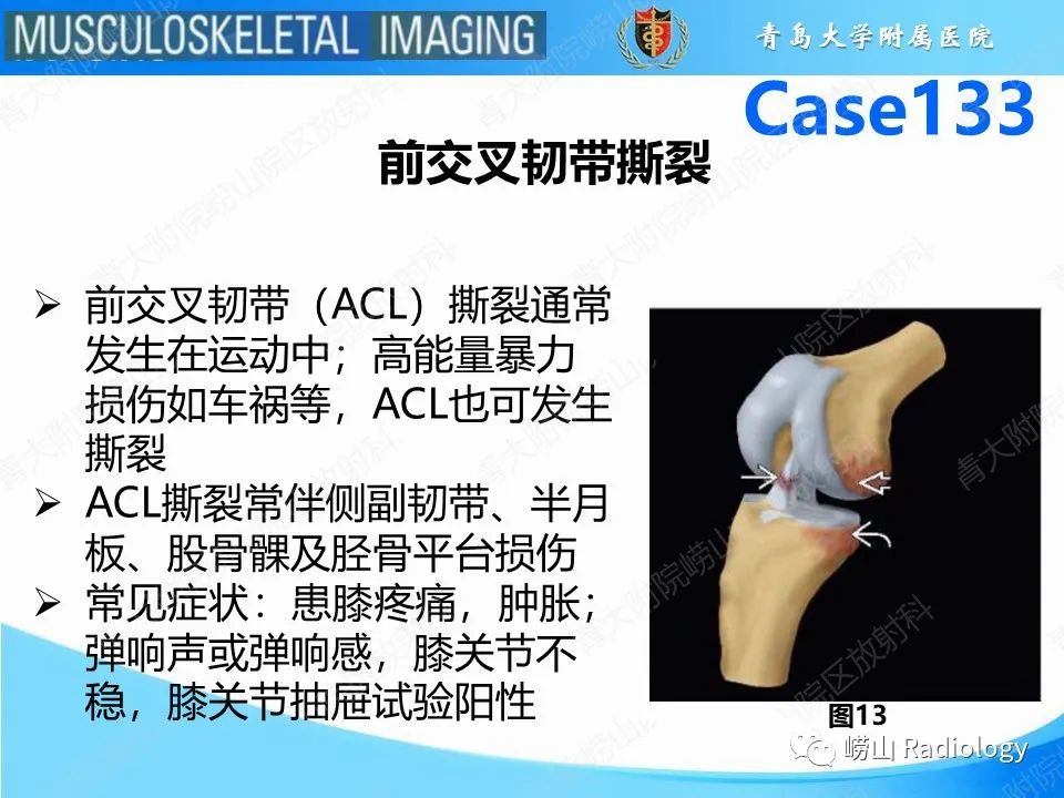 影像PPT - 【PPT】后交叉韧带撕裂-12