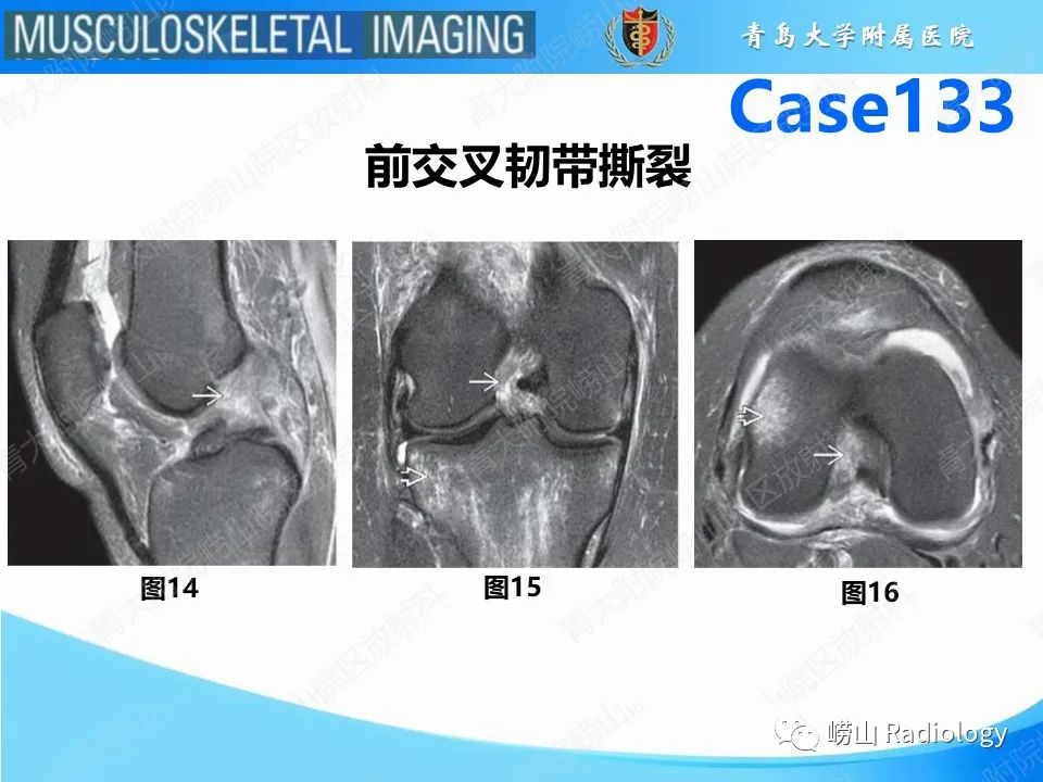 影像PPT - 【PPT】后交叉韧带撕裂-13