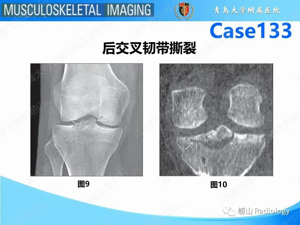 影像PPT - 【PPT】后交叉韧带撕裂-10