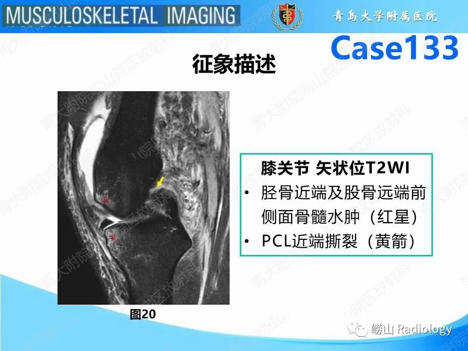 影像PPT - 【PPT】后交叉韧带撕裂-24