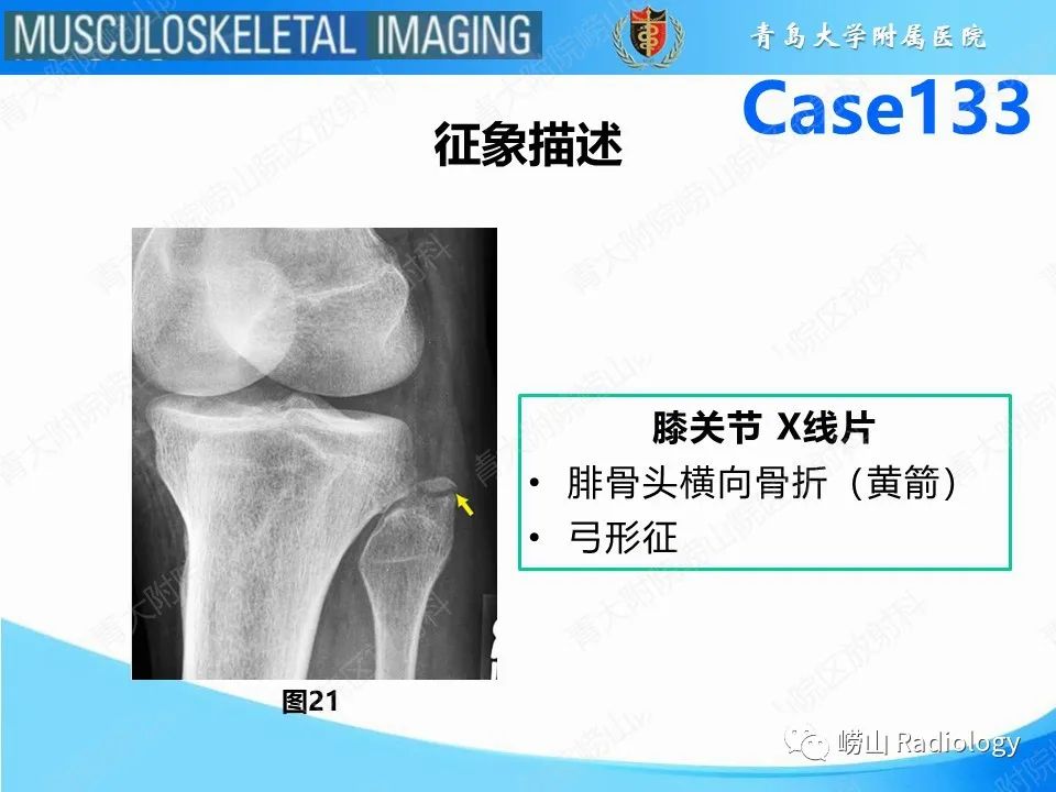 影像PPT - 【PPT】后交叉韧带撕裂-25
