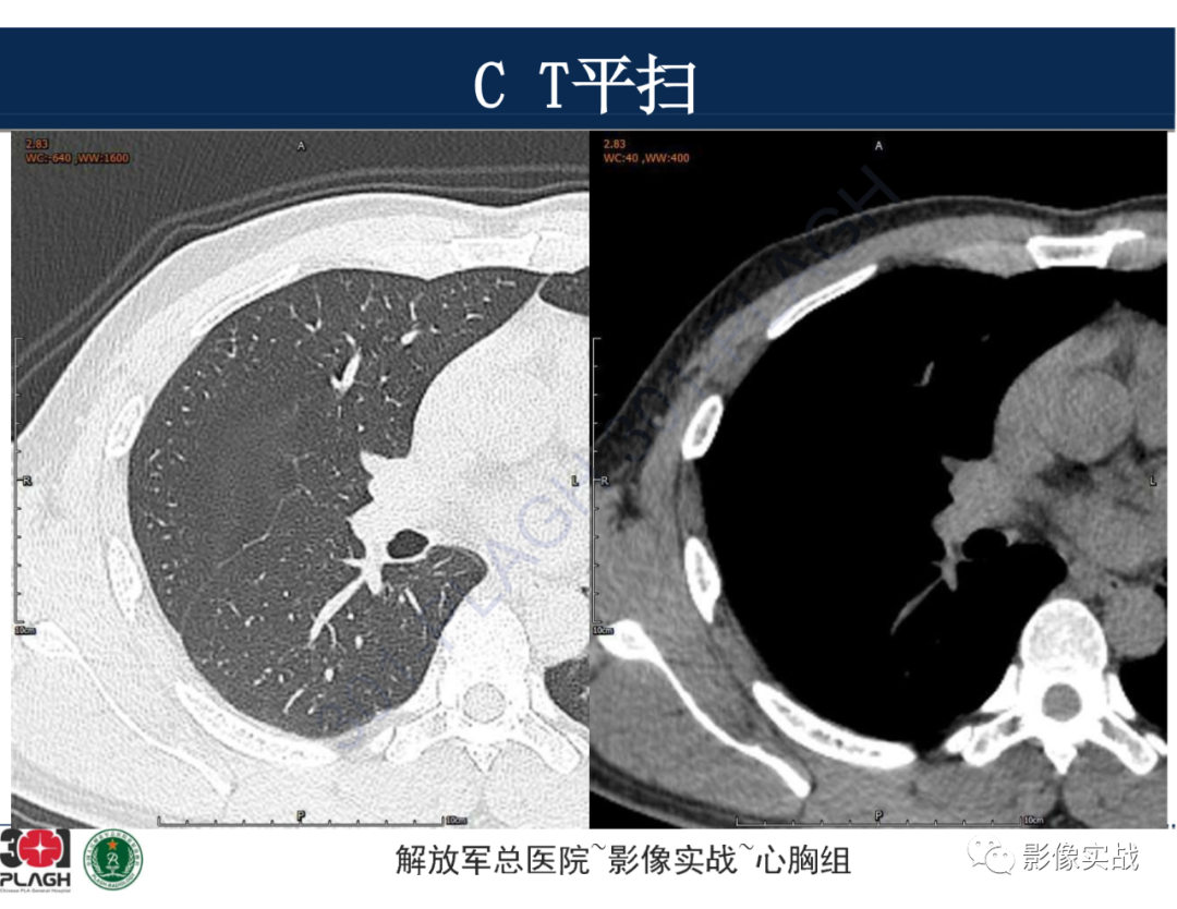 影像PPT - 【病例】肺浸润性腺癌1例CT-3